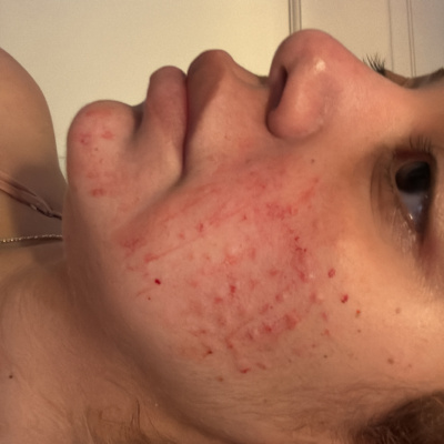 Rejuran HB photo review