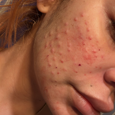 Rejuran HB photo review