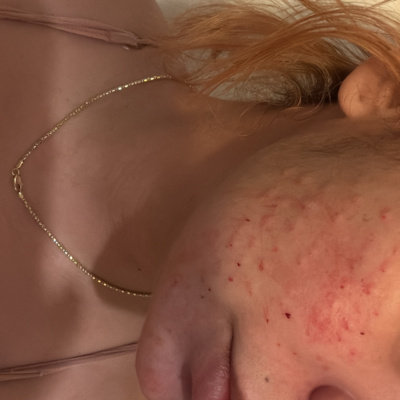 Rejuran HB photo review