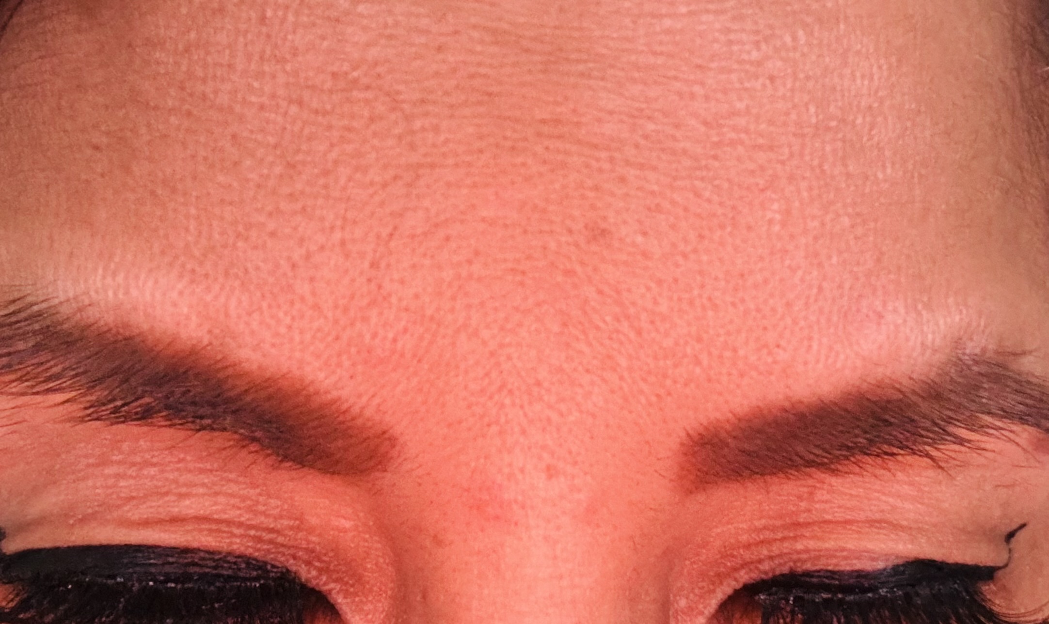 Innotox 100 Units photo review