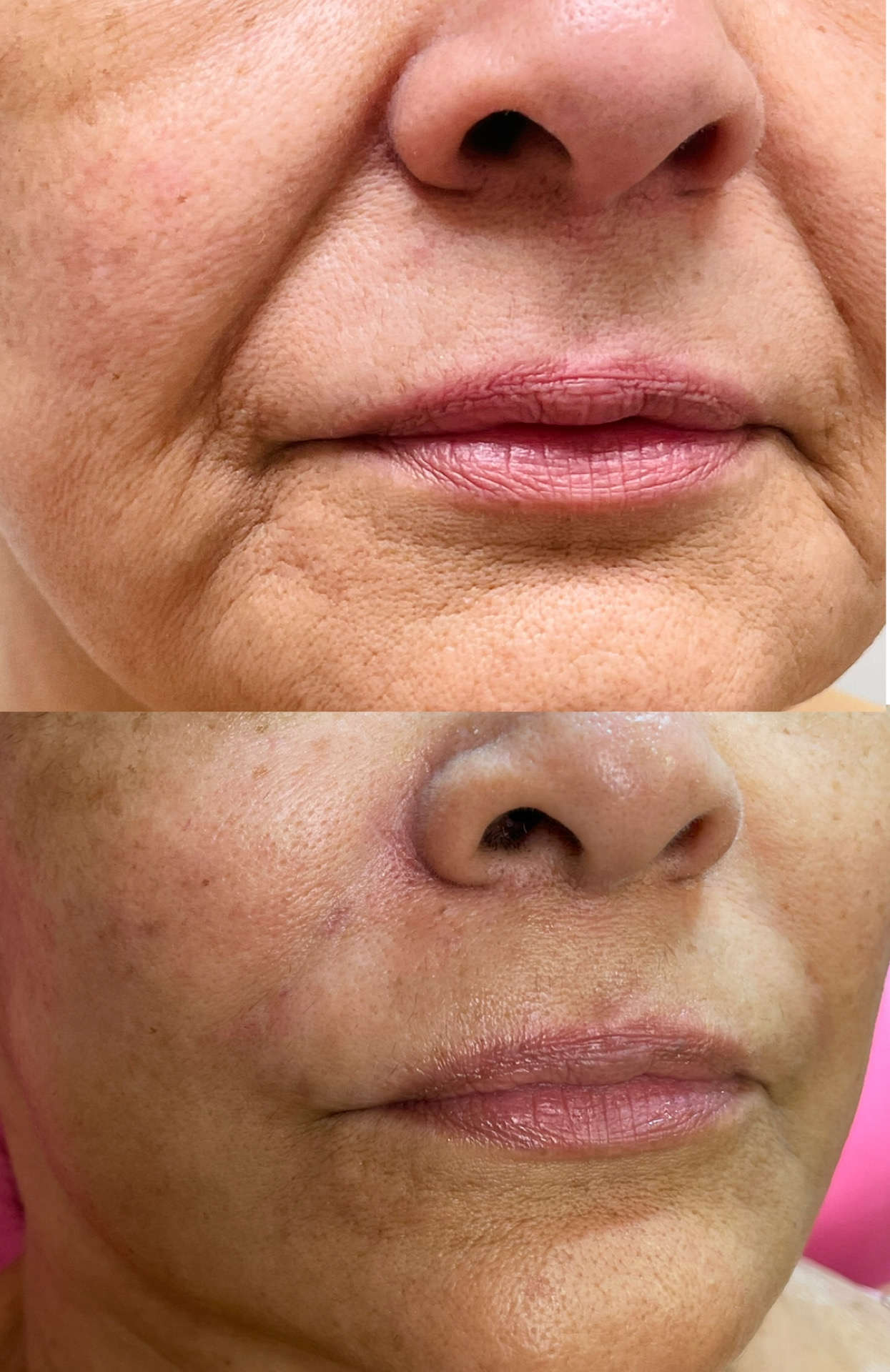 HyalDew ALL with Lidocaine photo review