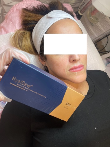 HyalDew MID with Lidocaine photo review