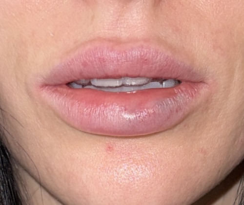 Neuramis Deep with Lidocaine photo review