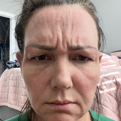 ReNTox 100 Units photo review