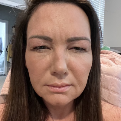 ReNTox 100 Units photo review