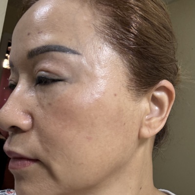 Rejuran Healer photo review