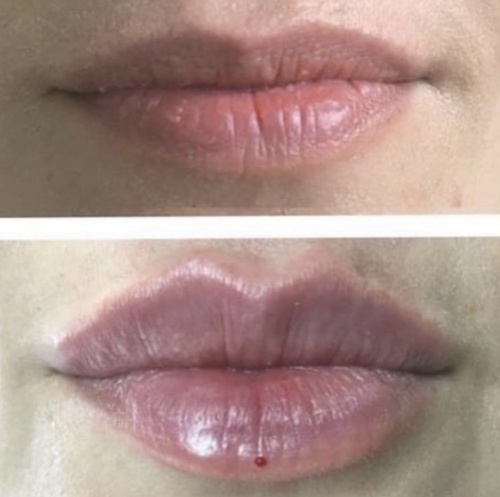 HyalDew ALL with Lidocaine photo review