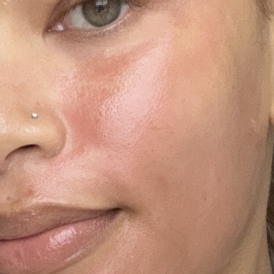 Rejuran Skin Booster photo review