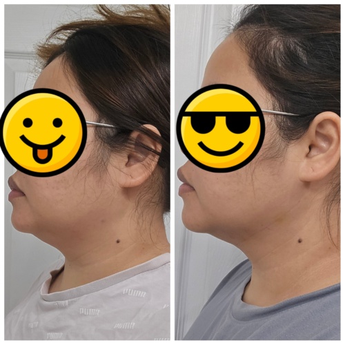 Dr. Lipo+ V (Face) photo review